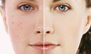serum ngừa mụn trắng da