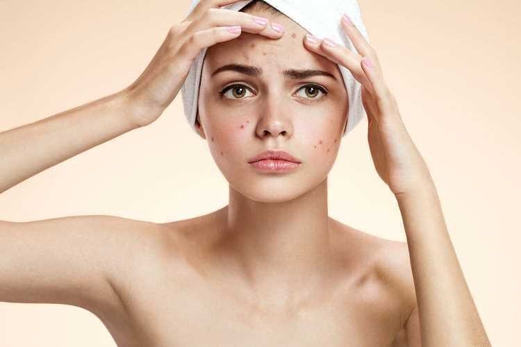 serum trị mụn kn beauty